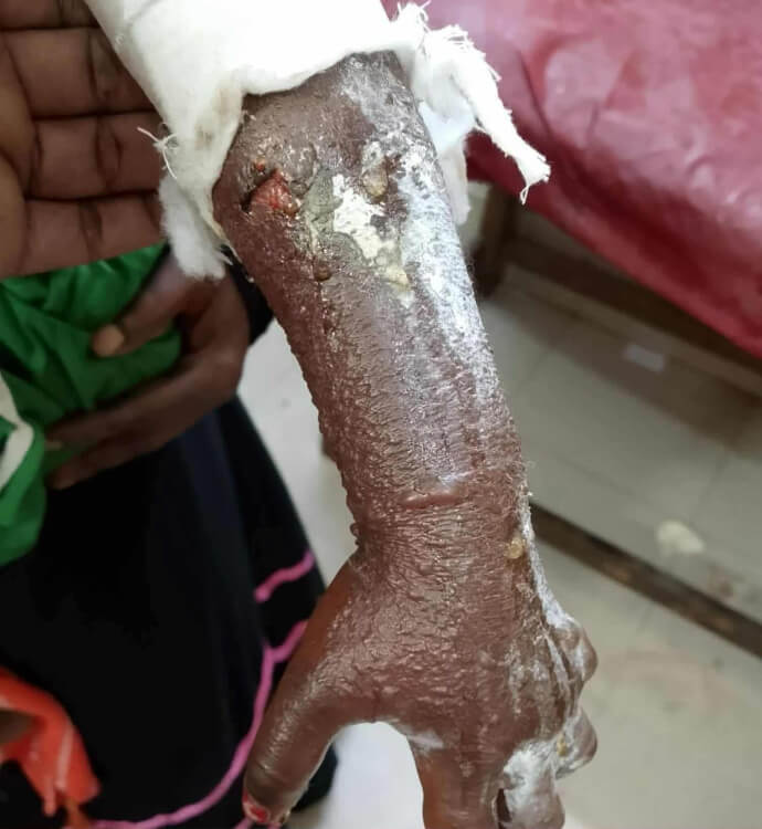 হাতুড়ে কবিরাজের চিকিৎসায় হাত হারাতে বসেছে ৪ বছরের শিশু কন্যা রুবাইদা